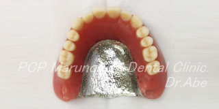 金属床総義歯