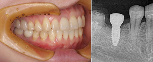 インプラントケース２