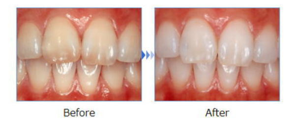 ホワイトニング ケース1